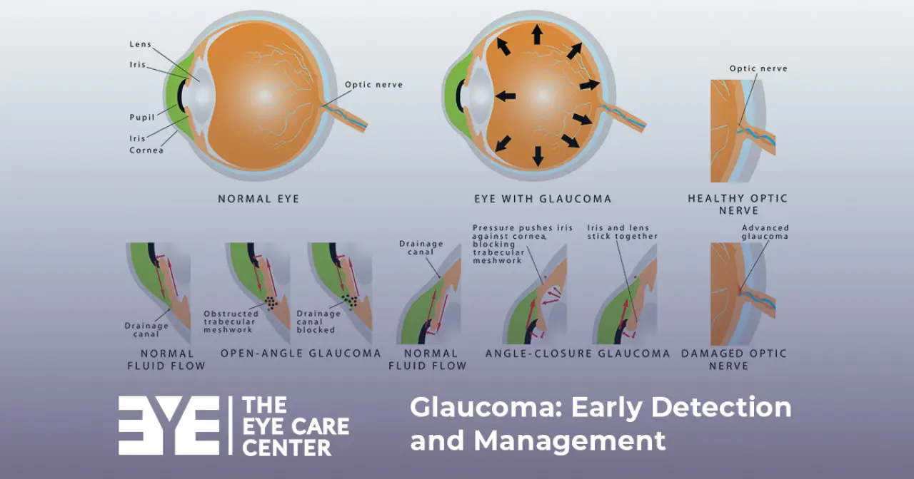 Glaucoma: Early Detection and Management
