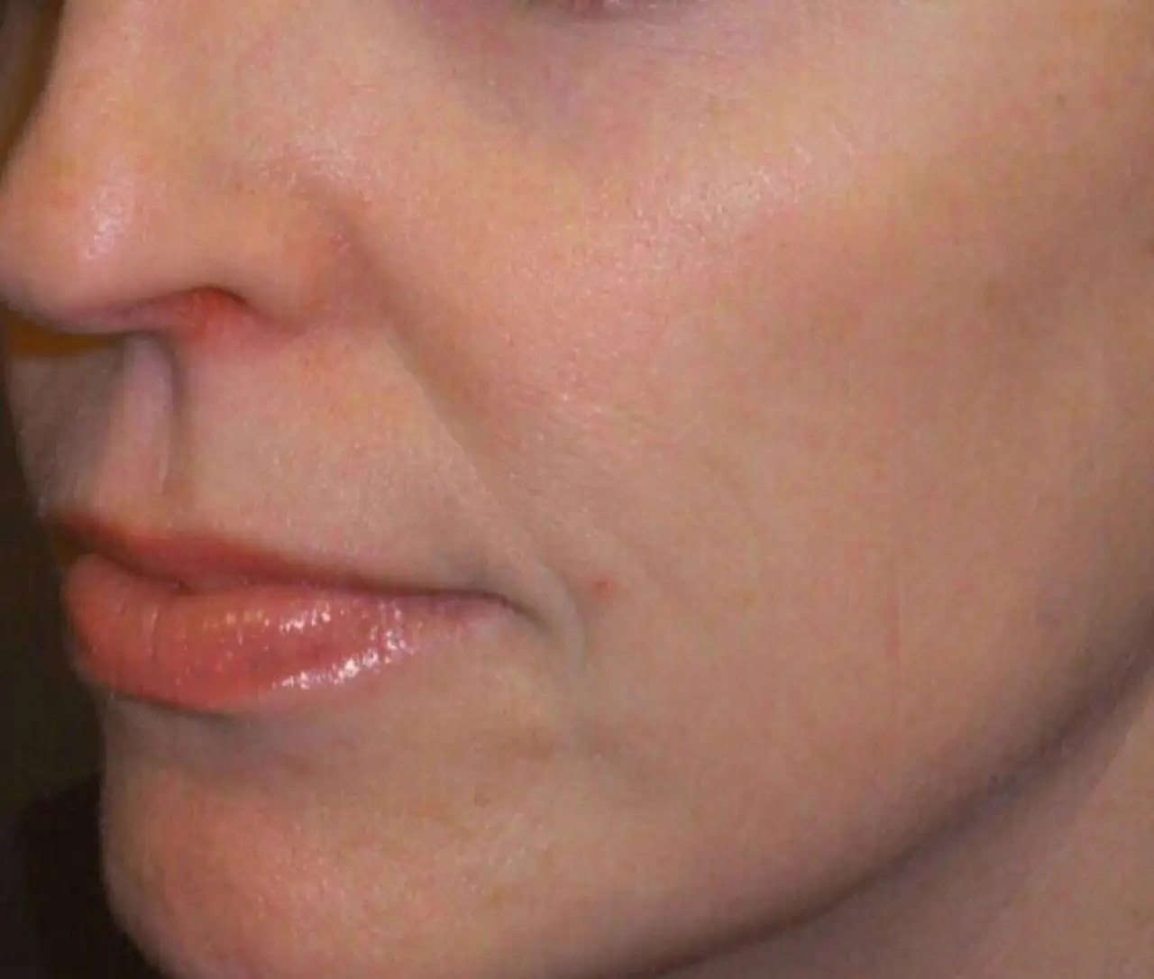 Patient After TriBella™ Anti-aging Treatment