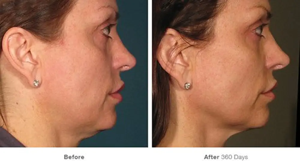 Side-by-side profile photos show a womans jawline before and after 360 days of treatment.