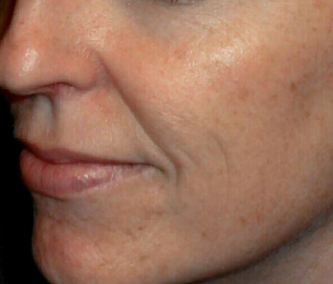 Patient Before TriBella™ Anti-aging Treatment
