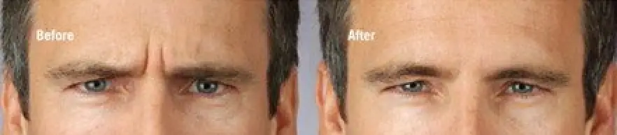 Before & After