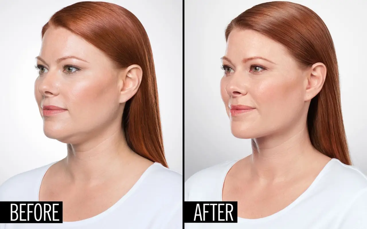 Side-by-side of a woman before and after, showing a reduced double chin in the after image.