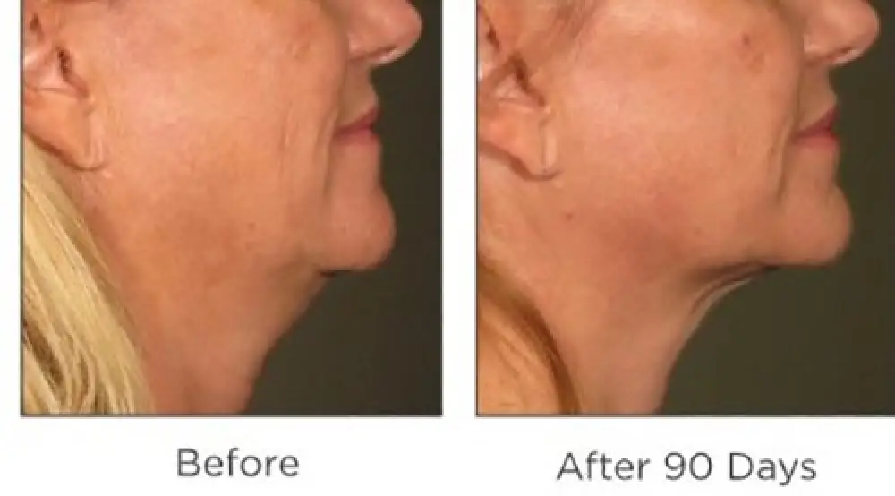 Side-by-side of a woman's jawline before and after 90 days, showing reduced sagging.