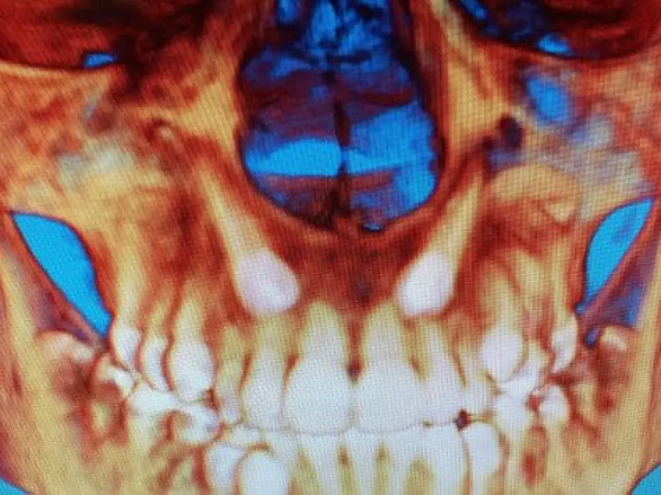 A dental X-ray showing an abnormal tooth structure and impacted teeth in the upper jaw.