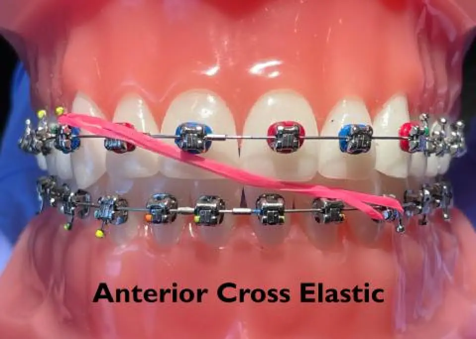 Model teeth with braces and a pink elastic band shown in an anterior cross elastic position.