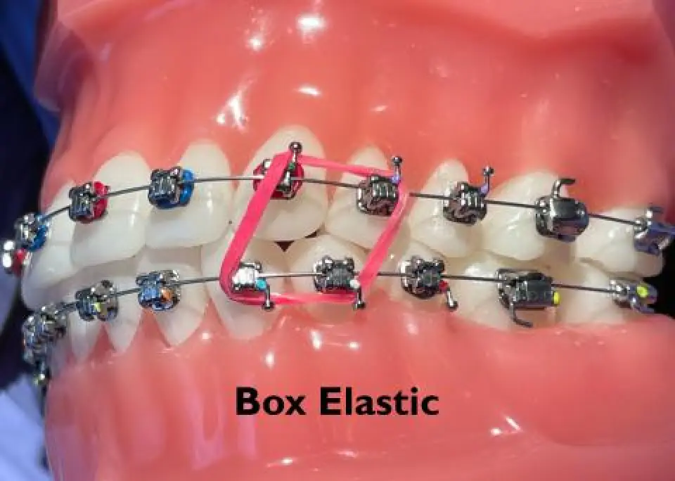 Close-up of teeth with braces and a pink box elastic, labeled Box Elastic.
