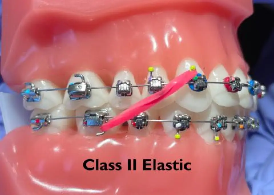 Dental model with braces and a pink elastic band stretched diagonally, labeled Class II Elastic.
