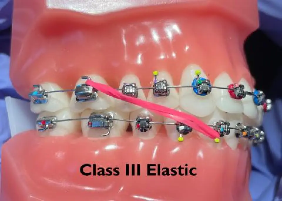Dental model with braces and a pink Class III elastic band stretching diagonally across teeth.