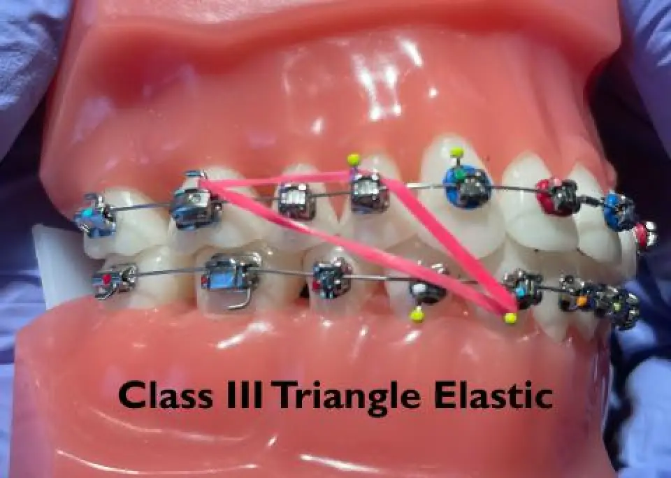 Dental model with braces showing pink elastic band in a Class III triangle configuration.