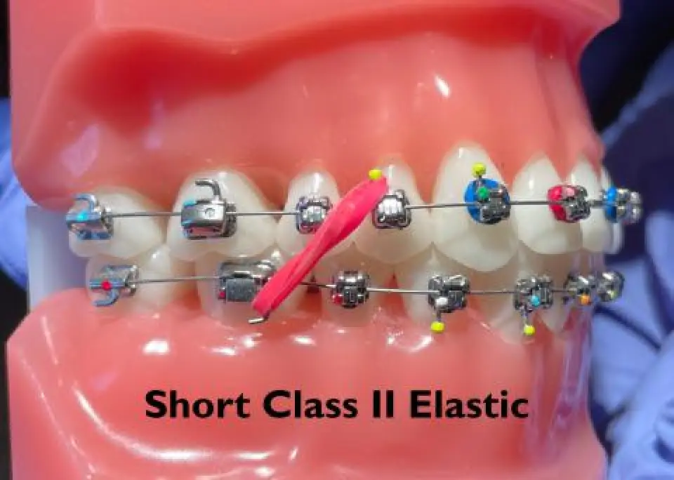 Dental model with braces and a pink elastic band labeled Short Class II Elastic.