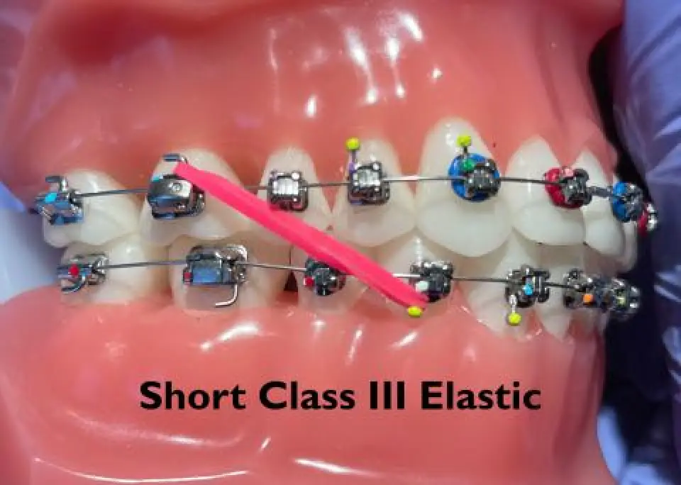 Dental model with braces and a pink elastic band labeled Short Class III Elastic.