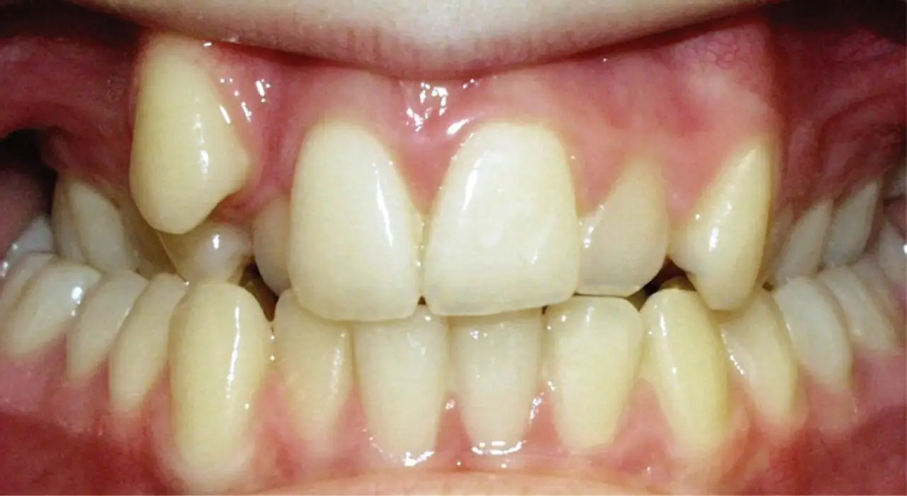 Close-up of teeth showing an upper canine tooth positioned higher than the adjacent teeth.