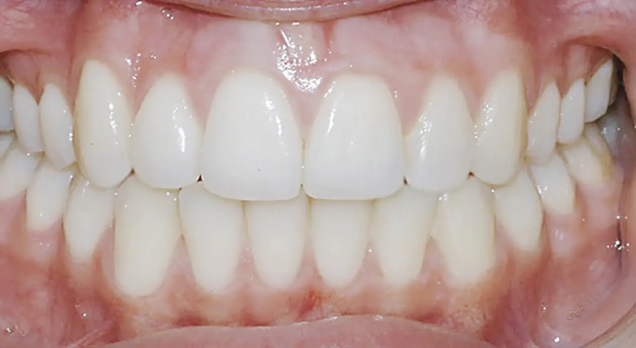 A close-up of a person's mouth showing clean, straight, and white upper and lower teeth.