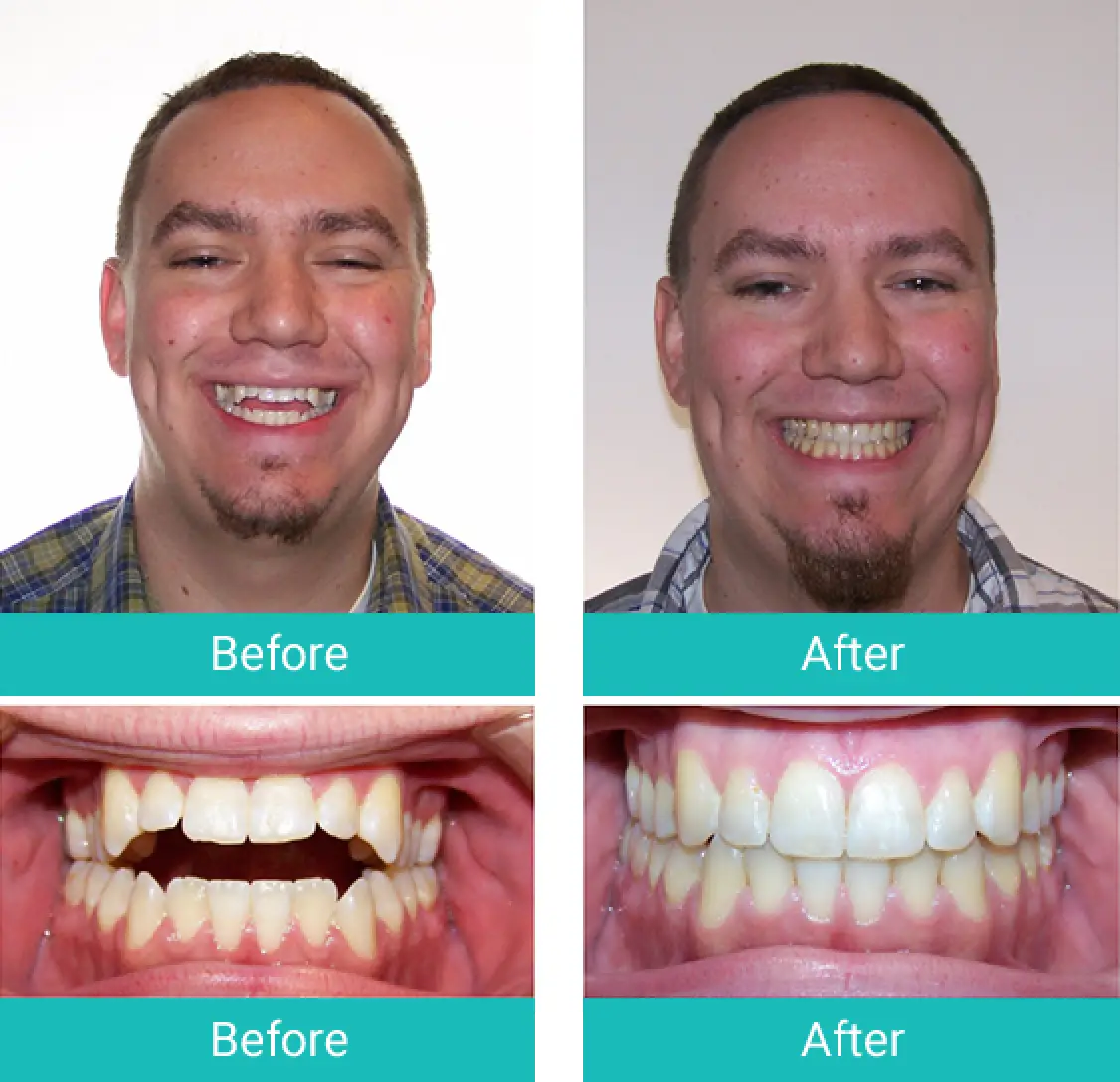 Smiling man’s teeth before and after dental treatment, showing noticeable improvement.