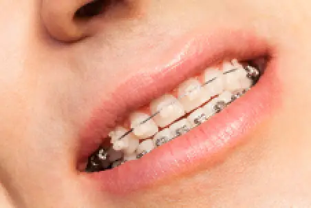 Close-up of a smiling mouth with ceramic braces on the upper teeth.