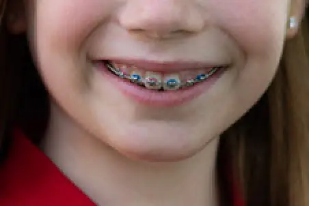 Close-up of a smiling child with braces on their teeth.