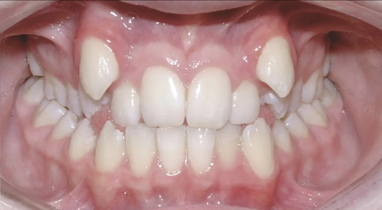 Close-up of teeth and gums showing dental crowding and misalignment in upper and lower jaws.