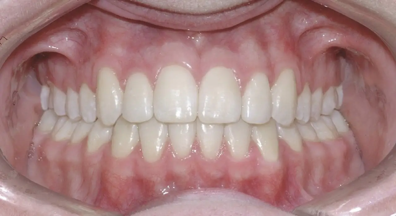 A close-up of a persons open mouth showing healthy teeth and gums.