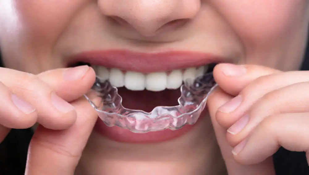 A woman putting a clear retainer into her mouth.
