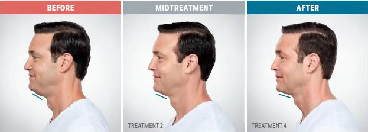 Side profile of a man showing chin changes labeled Before, Midtreatment, and After.