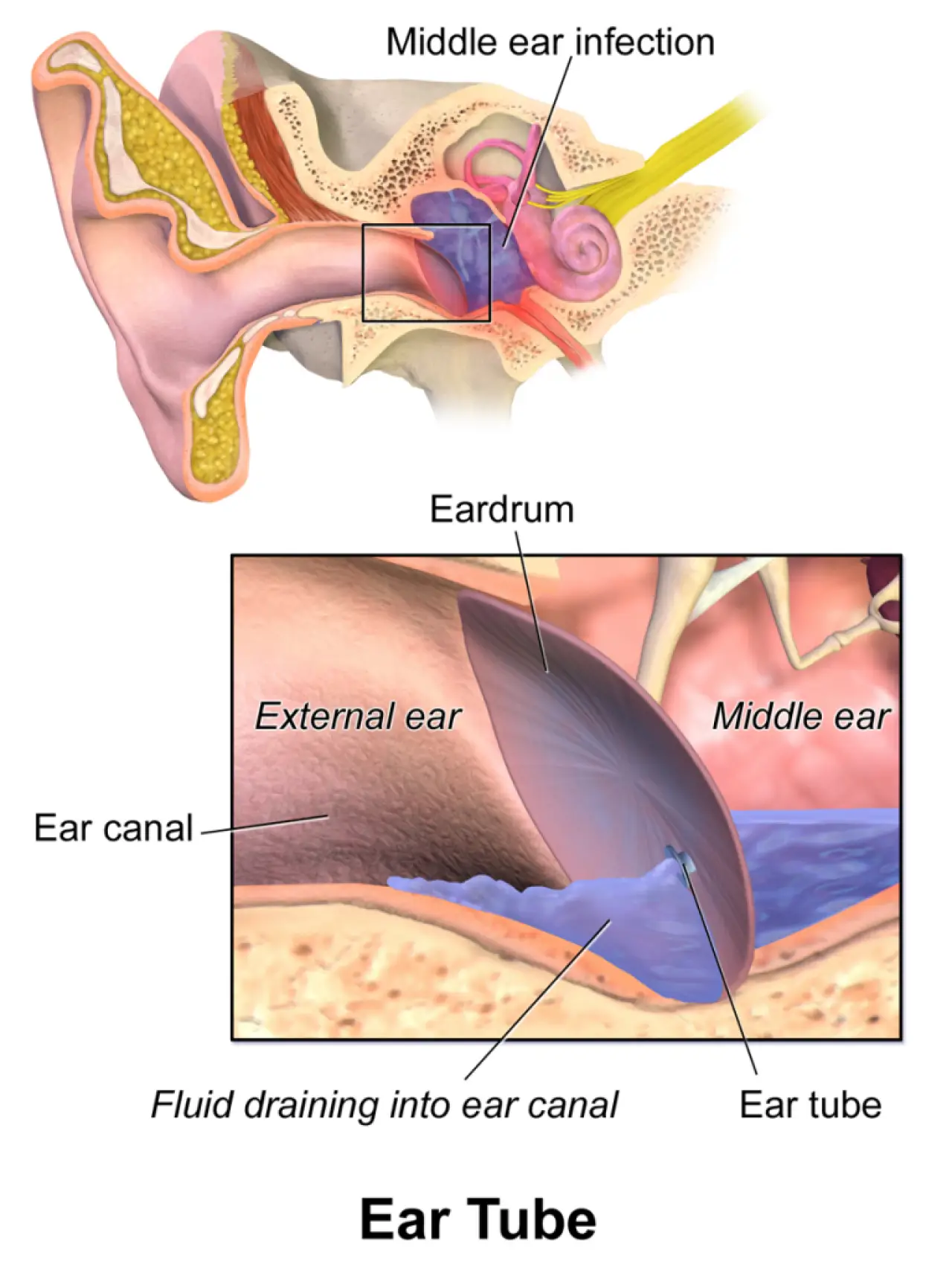 middle ear infection diagram