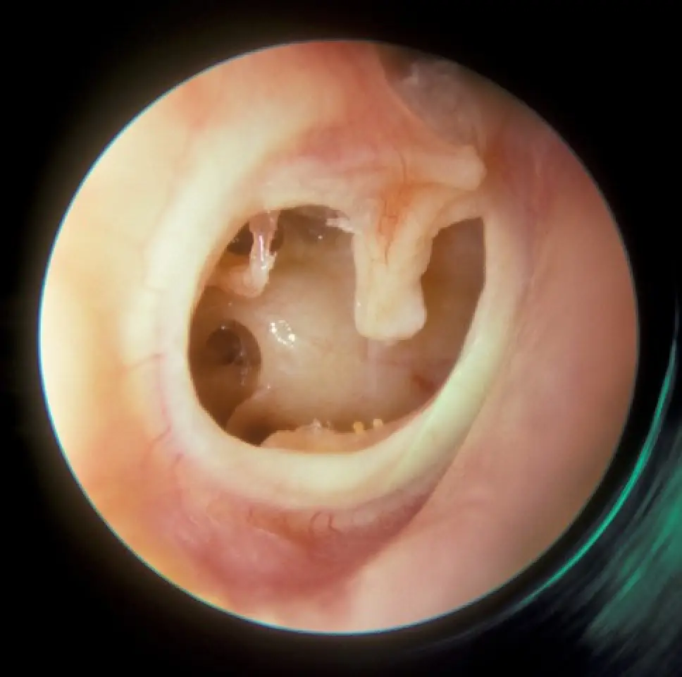 subtotal perforation of the right tympanic membrane