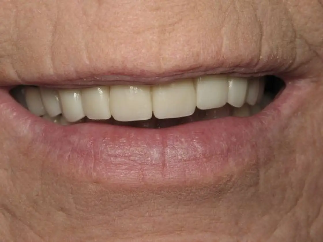 close up of brends after her mouth restoration