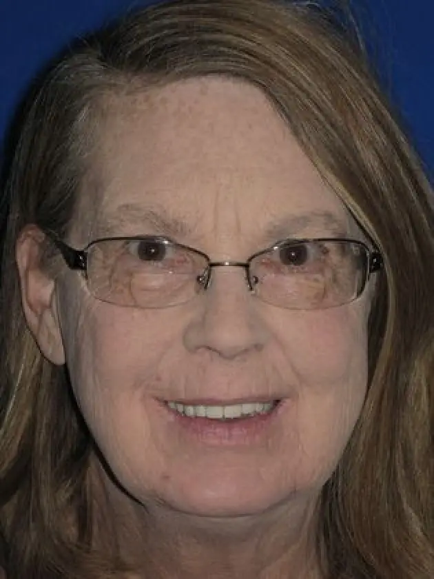 brenda smiling after mouth restoration