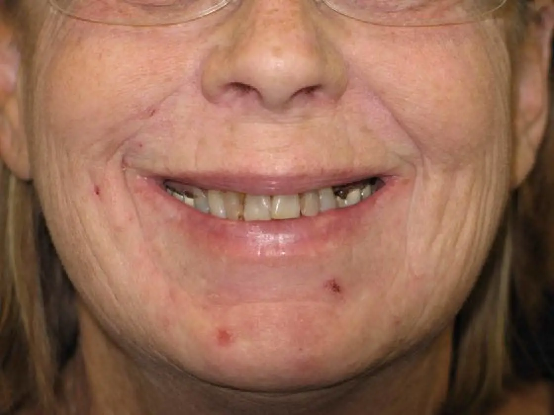 close up of brenda before her mouth restoration