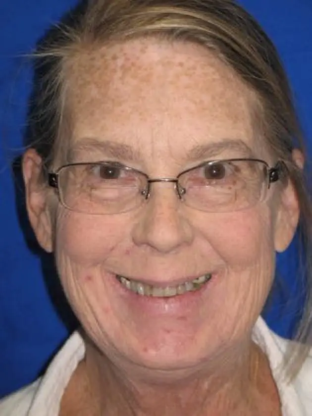 brenda similing before mouth restoration