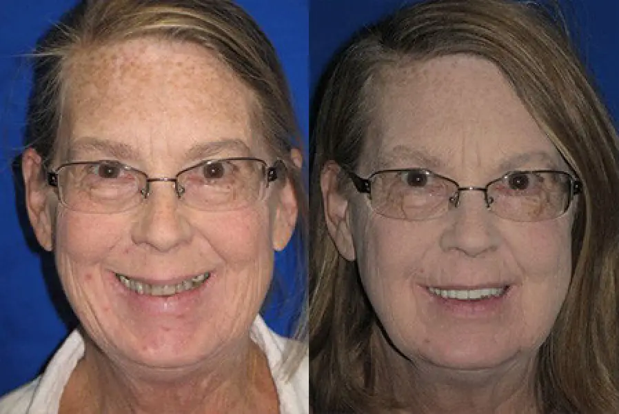 patient brenda before and after