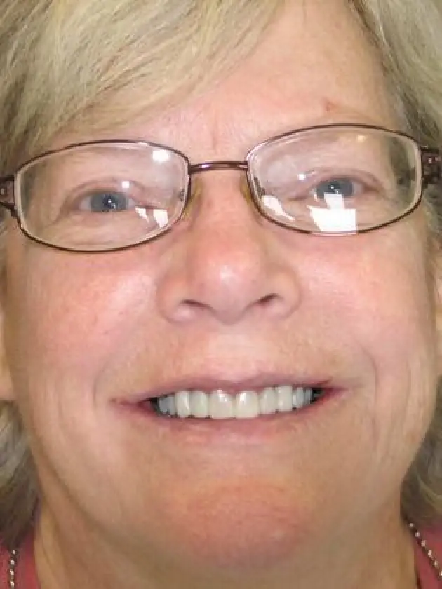 carol smiling after her mouth restoration