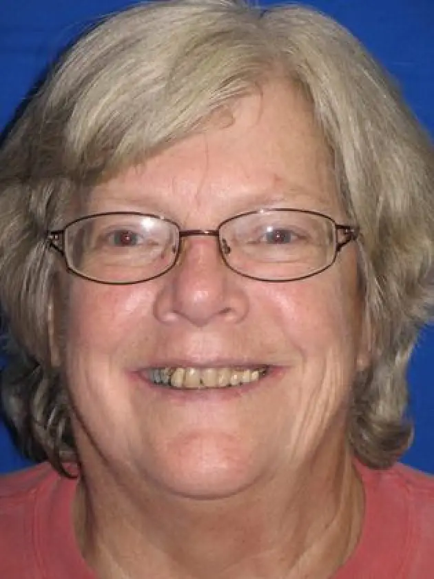 carol smiling beofre her mouth restoration