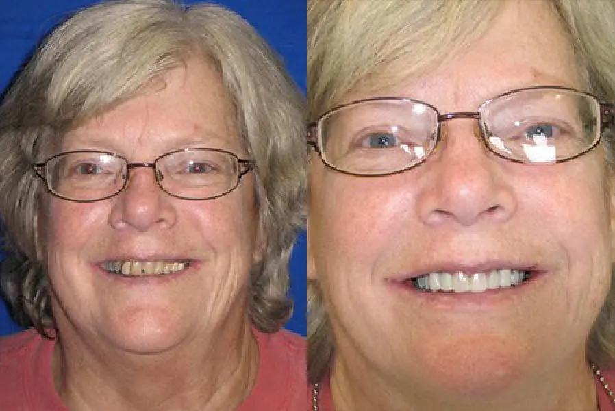 patient carol before and after