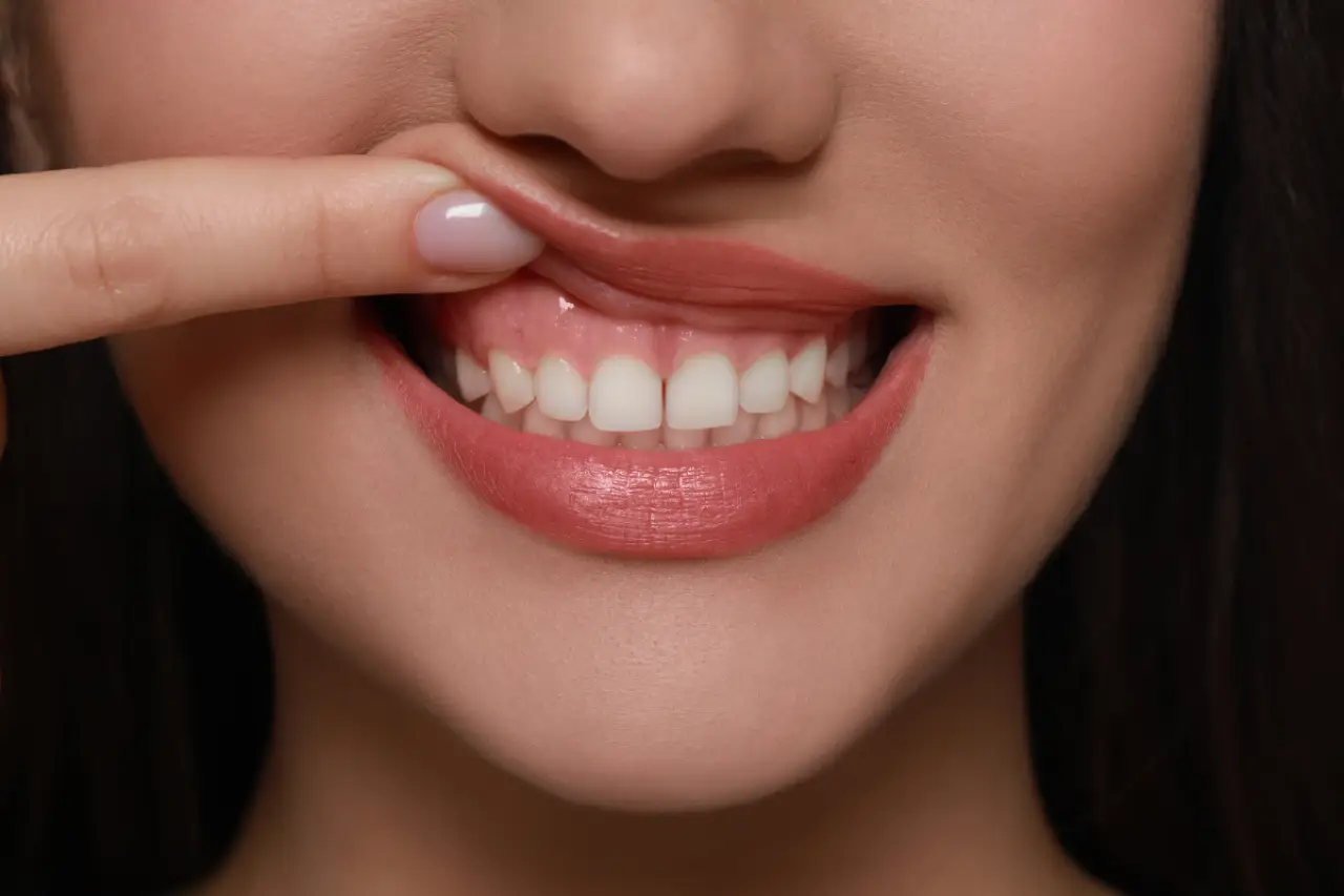 gummy smile before gum contouring