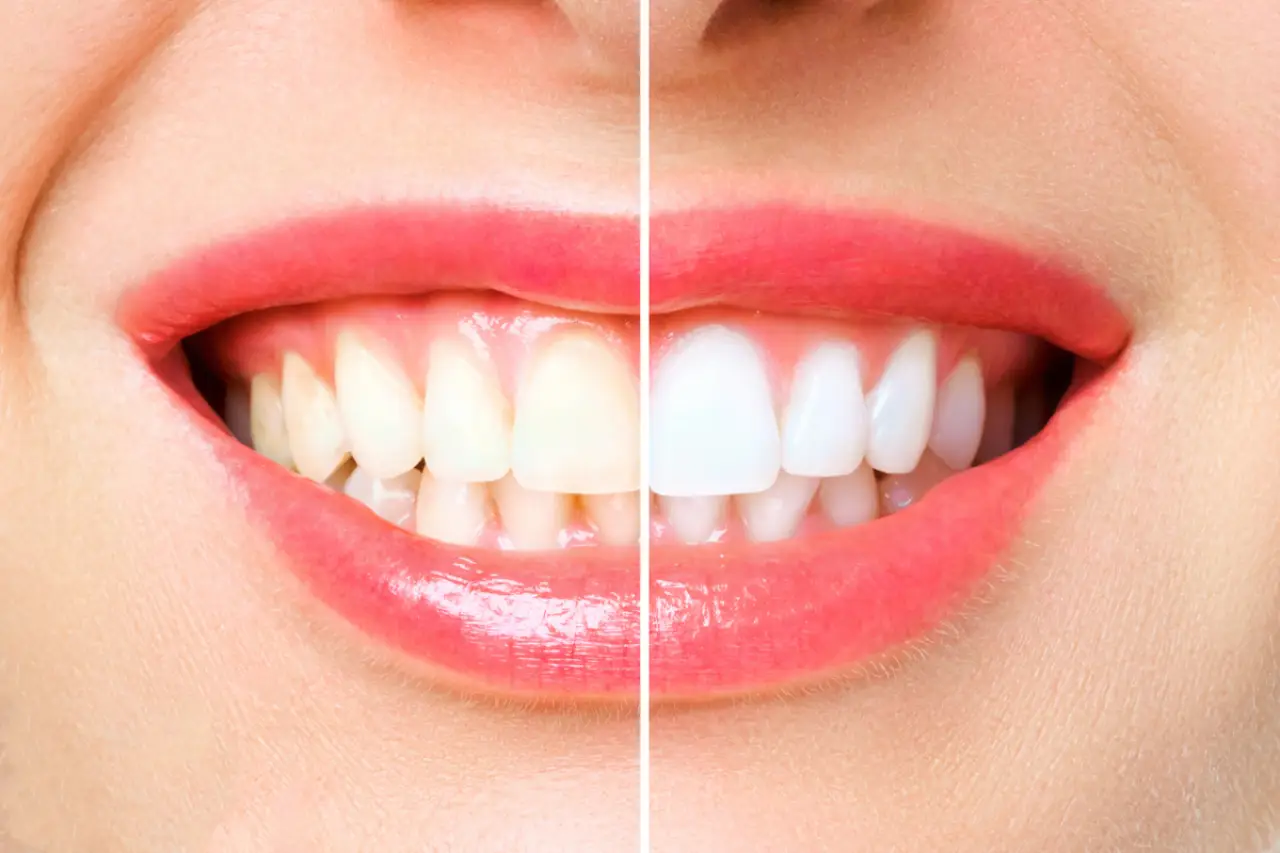 teeth whitening before and after