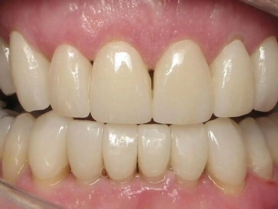 dave after smile makeover close up