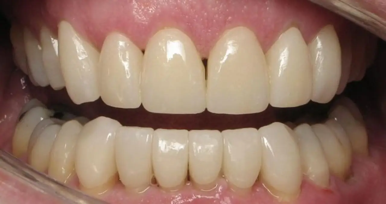 dave open smile after smile makeover