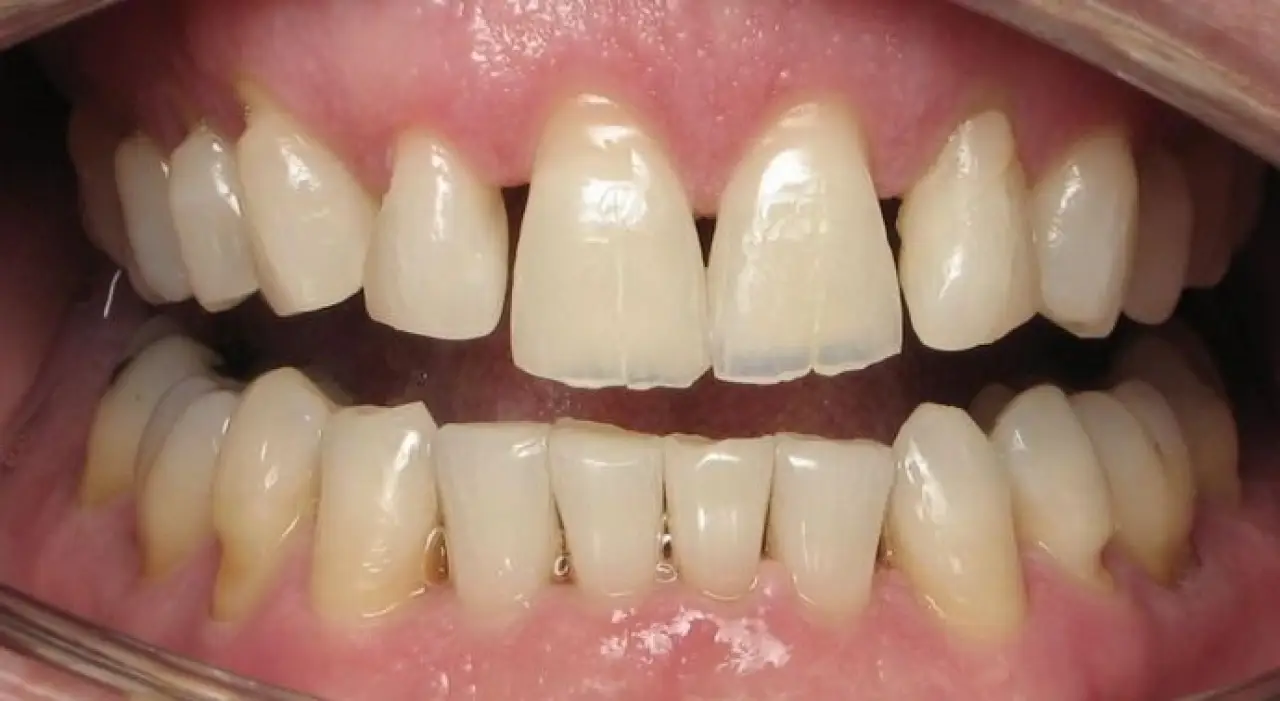 dave before smile makeover open mouth smile