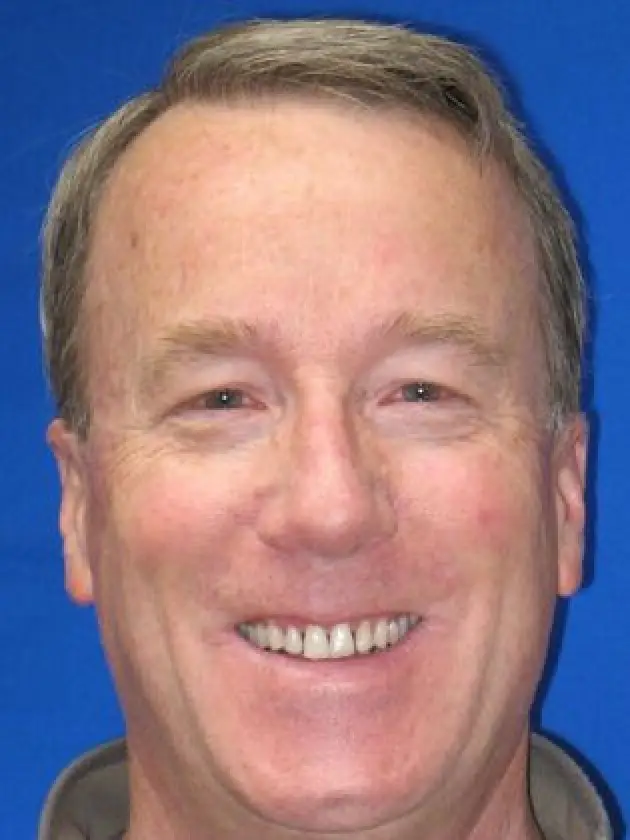 dave smiling before smile makeover