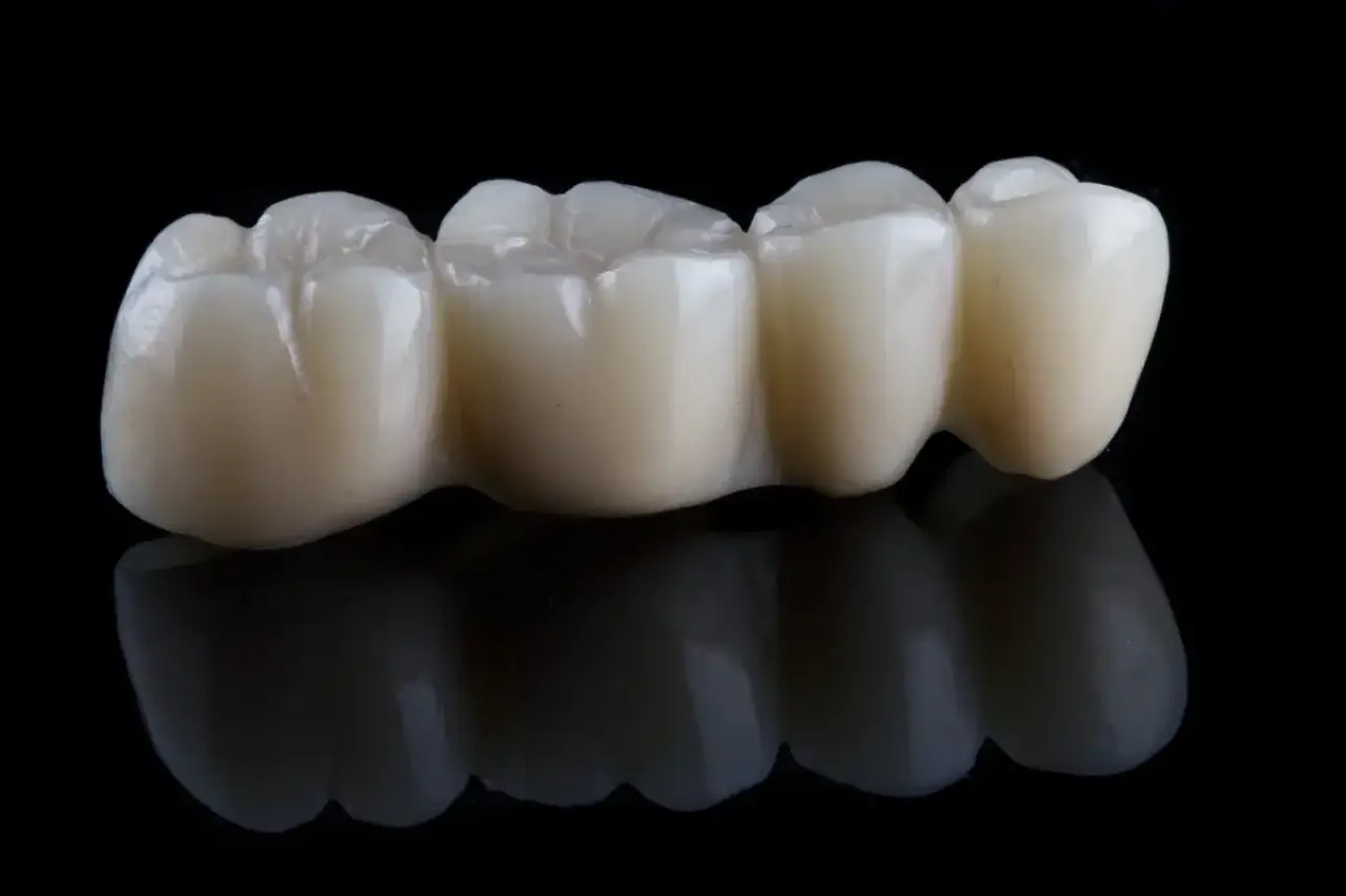 Dental Bridges