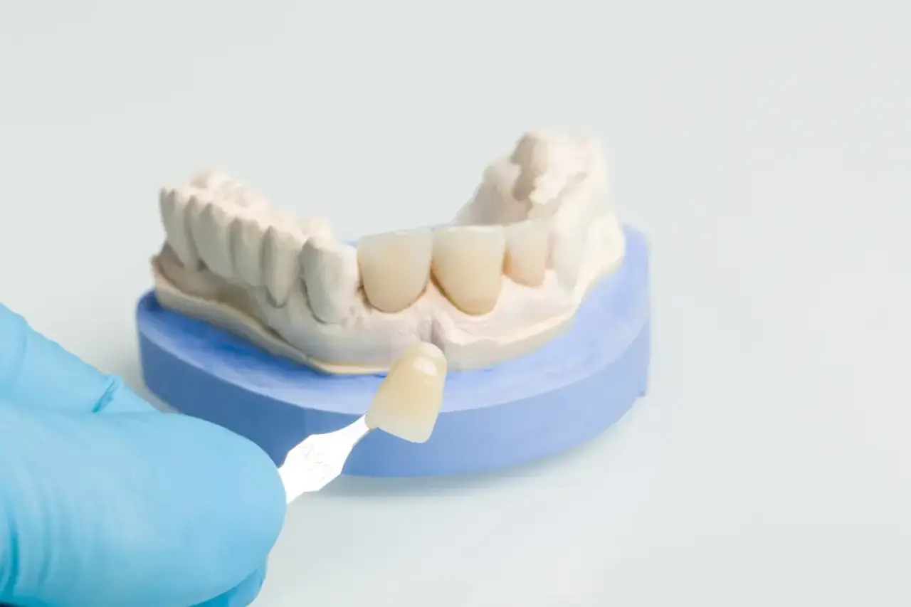 dental crowns