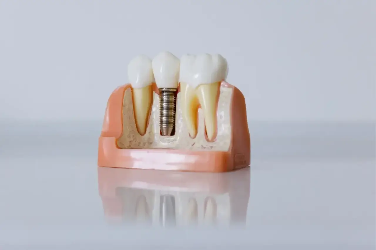 Dental Implants