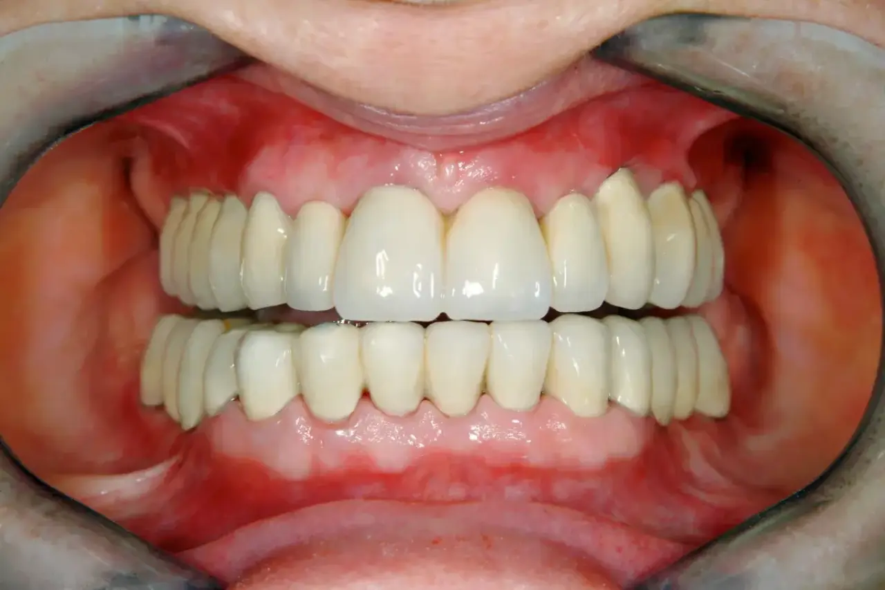 Teeth Reconstruction