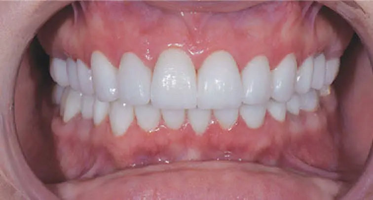 after dental work