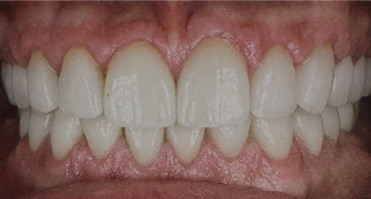 after dental work