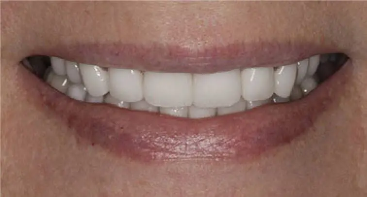 after dental work