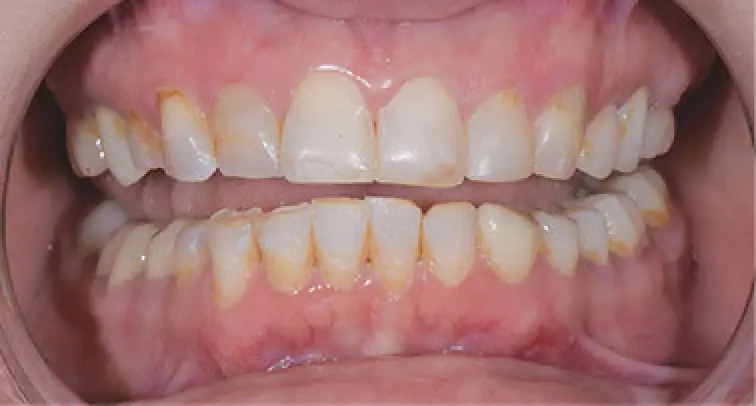 before dental work