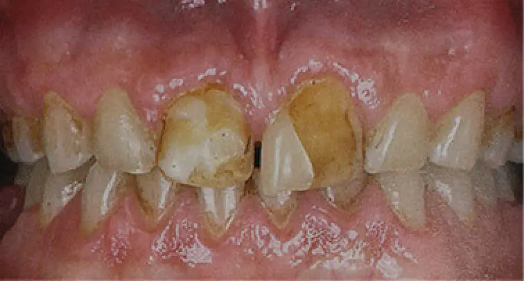 before dental work