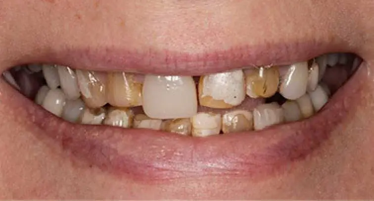 before dental work